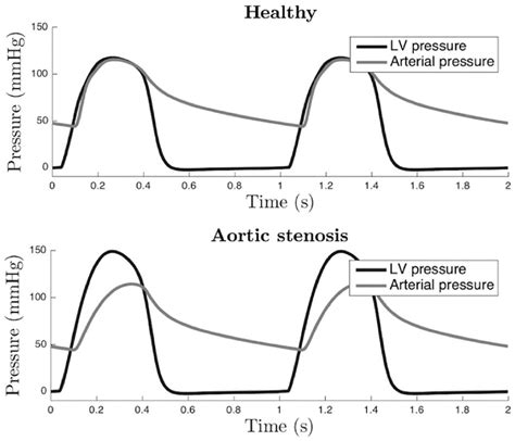 lv stj|Aortic stenosis .